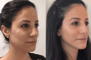 Langanhaltende Ergebnisse mit ellanse filler erleben